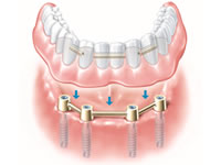 implant full