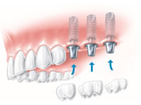 implant multiple