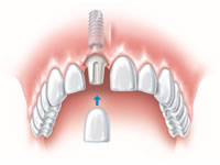 implant single