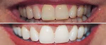 teeth whitening