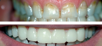 veneers